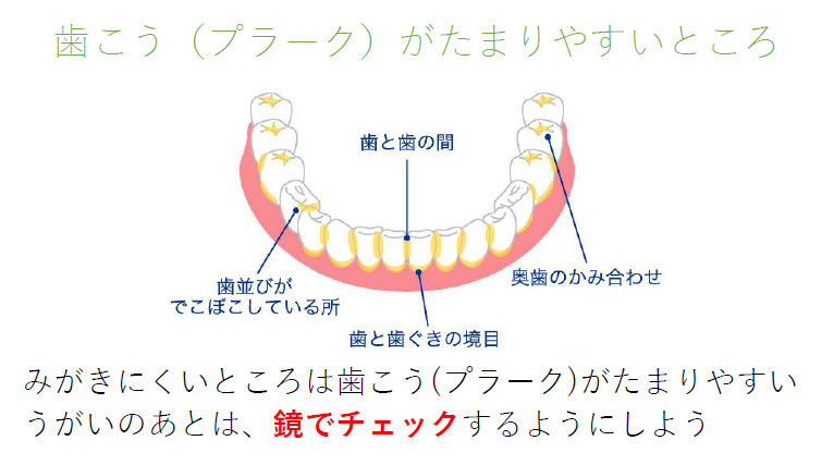 歯垢がたまりやすいところのイラスト